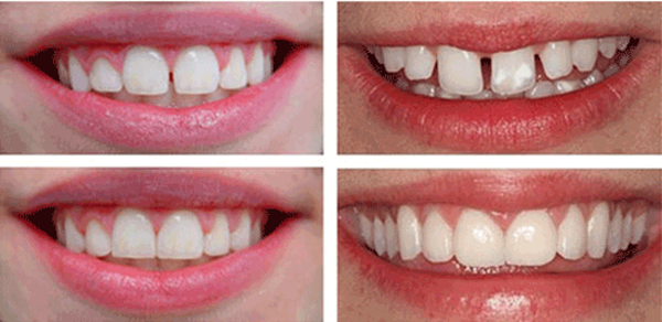 بستن فاصله میان دندان ها؛ بهترین روش کدام است؟